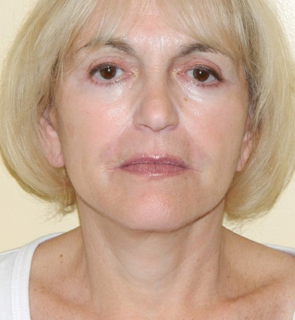 Mini Facelift Before & After Patient #2998