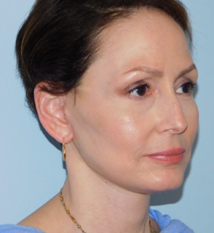 Mini Facelift Before & After Patient #2997