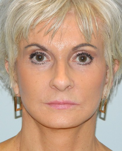 Mini Facelift Before & After Patient #2996