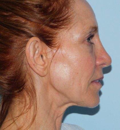 Mini Facelift Before & After Patient #2993
