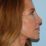 Mini Facelift Before & After Patient #2993