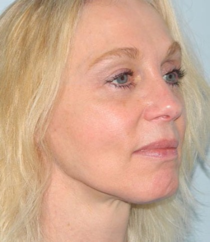 Mini Facelift Before & After Patient #2951