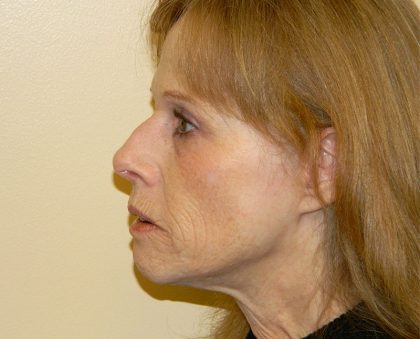 Mini Facelift Before & After Patient #2950