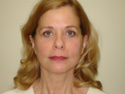 Mini Facelift Before & After Patient #2949