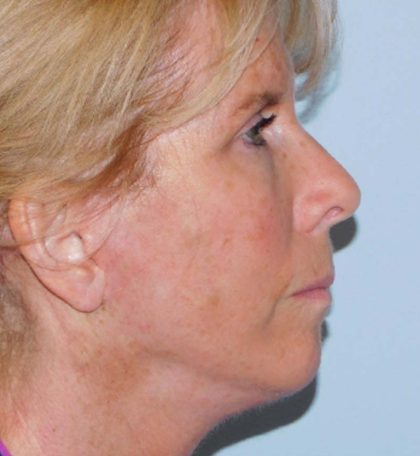 Mini Facelift Before & After Patient #2948