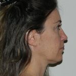 Mini Facelift Before & After Patient #2947