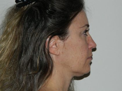 Mini Facelift Before & After Patient #2947