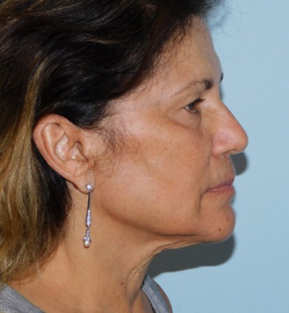 Mini Facelift Before & After Patient #2907
