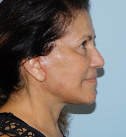 Mini Facelift Before & After Patient #2907