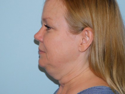Mini Facelift Before & After Patient #2905