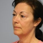Mini Facelift Before & After Patient #2904