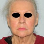 Mini Facelift Before & After Patient #2903