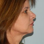 Mini Facelift Before & After Patient #2902
