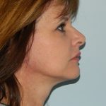 Mini Facelift Before & After Patient #2902