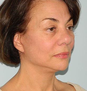Mini Facelift Before & After Patient #2863
