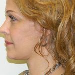 Mini Facelift Before & After Patient #2861