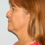 Mini Facelift Before & After Patient #2860