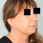 Mini Facelift Before & After Patient #2859