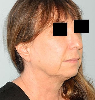 Mini Facelift Before & After Patient #2859