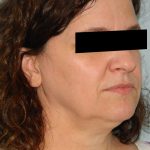 Mini Facelift Before & After Patient #2858