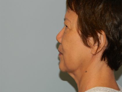 Mini Facelift Before & After Patient #2822