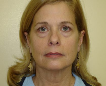 Blepharoplasty Before & After Patient #3183