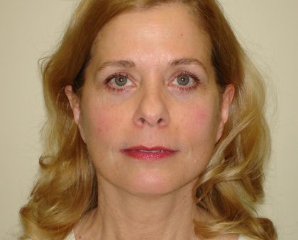 Blepharoplasty Before & After Patient #3183