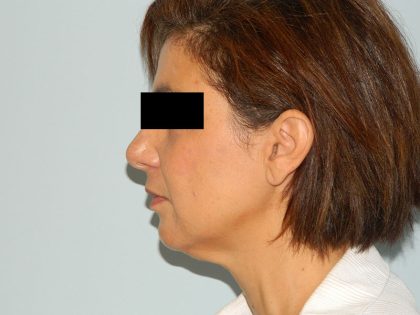 Mini Facelift Before & After Patient #2821