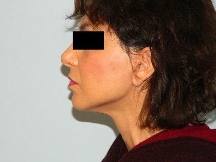Mini Facelift Before & After Patient #2821