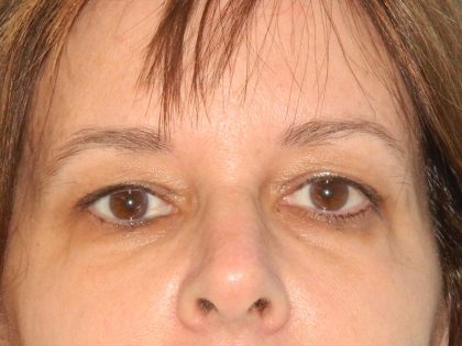 Blepharoplasty Before & After Patient #3130
