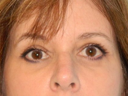 Blepharoplasty Before & After Patient #3130