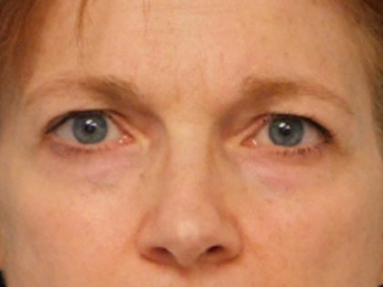 Blepharoplasty Before & After Patient #3158