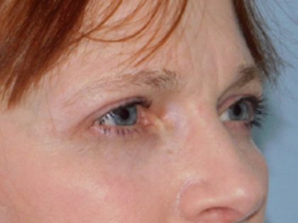 Blepharoplasty Before & After Patient #3158