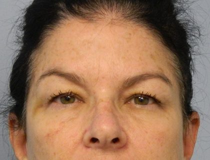 Blepharoplasty Before & After Patient #3156