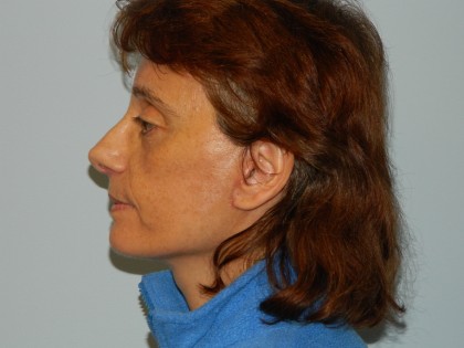 Mini Facelift Before & After Patient #2814