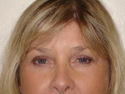 Blepharoplasty Before & After Patient #3155