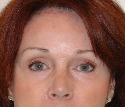 Blepharoplasty Before & After Patient #3154