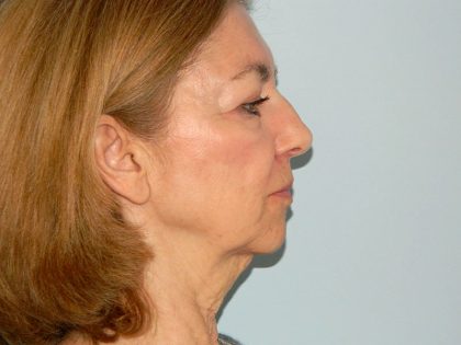 Mini Facelift Before & After Patient #2783