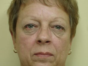 Blepharoplasty Before & After Patient #3128
