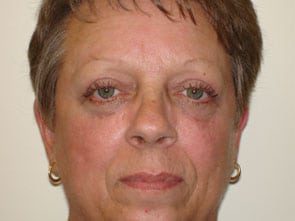 Blepharoplasty Before & After Patient #3128