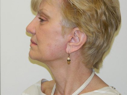 Mini Facelift Before & After Patient #2782