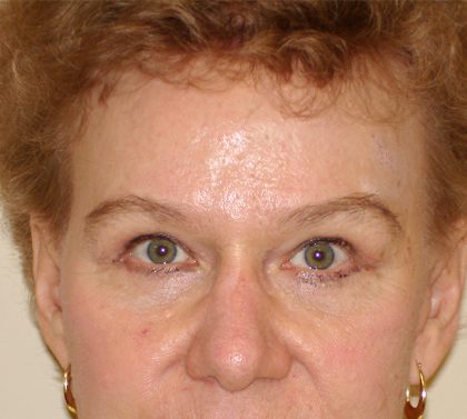 Blepharoplasty Before & After Patient #3126