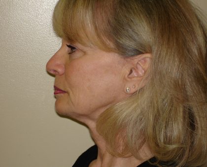 Mini Facelift Before & After Patient #2749