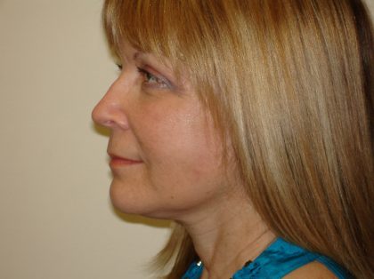 Mini Facelift Before & After Patient #2748