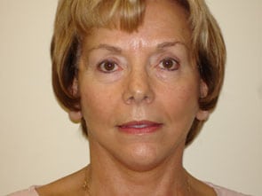 Mini Facelift Before & After Patient #2747