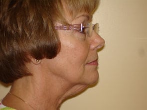 Mini Facelift Before & After Patient #2747