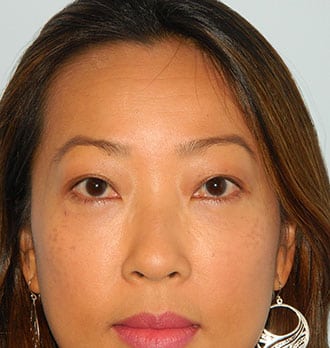 Blepharoplasty Before & After Patient #3095