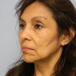 Blepharoplasty Before & After Patient #3094