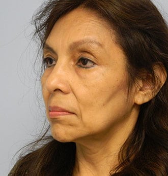 Blepharoplasty Before & After Patient #3094