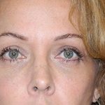 Blepharoplasty Before & After Patient #3093
